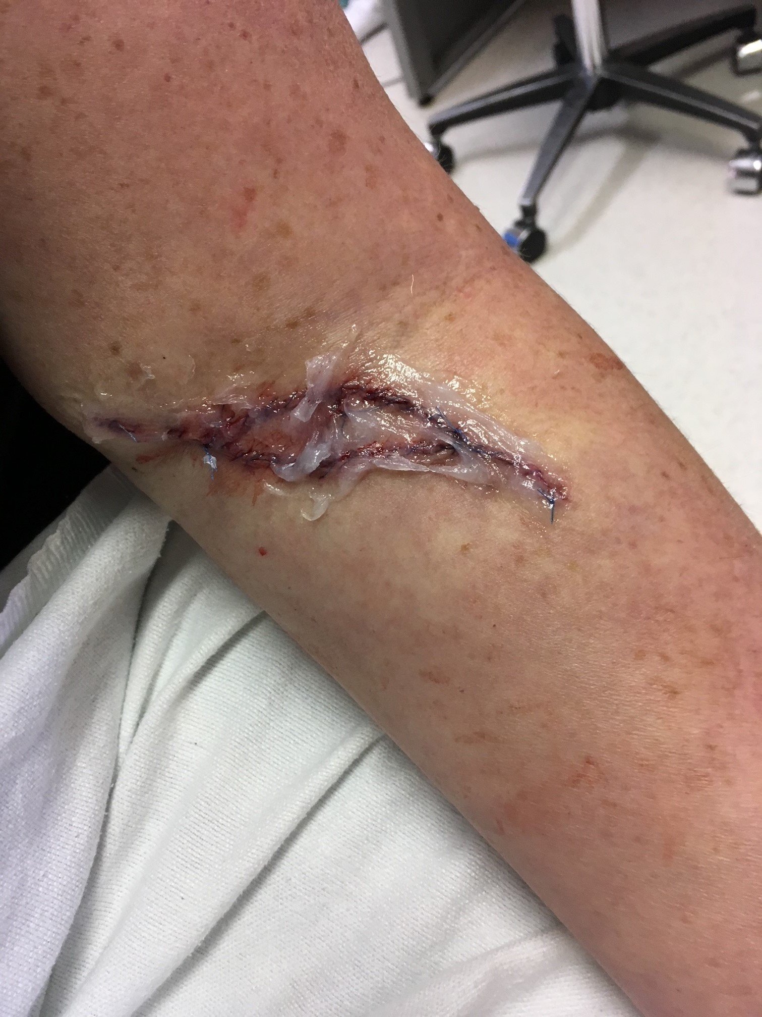 Since her first diagnosis, Ellerbe has had numerous cancerous and pre-cancerous spots removed, including one on her arm. The cancer on her arm was so deep that she has nerve damage from the removal, and is no longer able to get blood drawn from that arm.