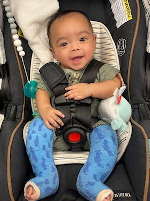 Jazael had seven weeks of progressive casting treatment and therapy for his bilateral clubfoot. (Photo provided by family)