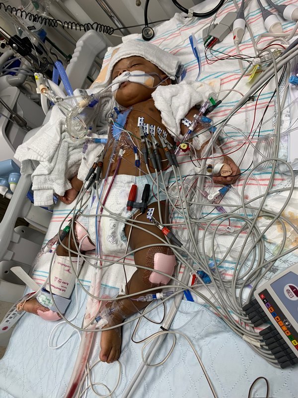 9-month-old Imani after receiving his second and final surgery, an atrial switch procedure that helped restore blood flow through the ventricles. (Photo by Amira Carson)