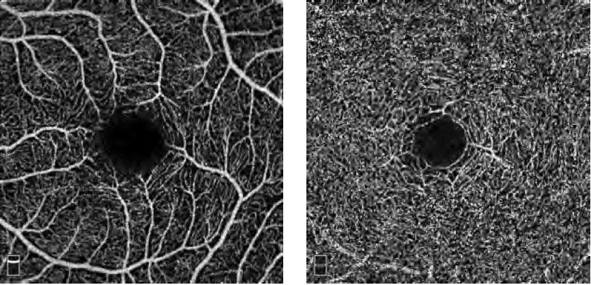 In the future, portable retina imaging systems could be the key to diagnosing acute strokes
