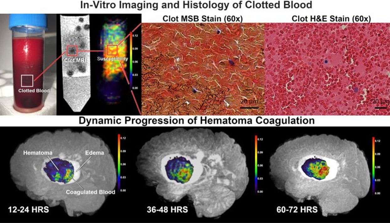 Dynamic Imaging of Blood Coagulation Within the Hematoma of Patients With Acute Hemorrhagic Stroke