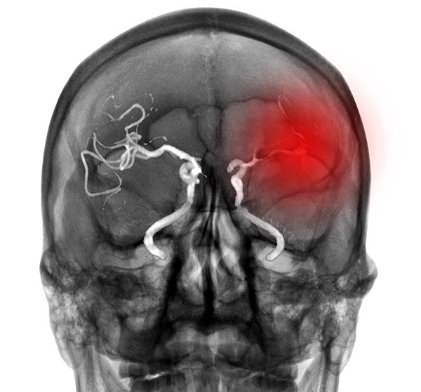 New research from the BRAINS Research Laboratory at UTHealth reveals that inter-alpha inhibitor proteins (IAIP) could potentially represent a key, novel treatment for ischemic stroke. (Photo by Getty Images)