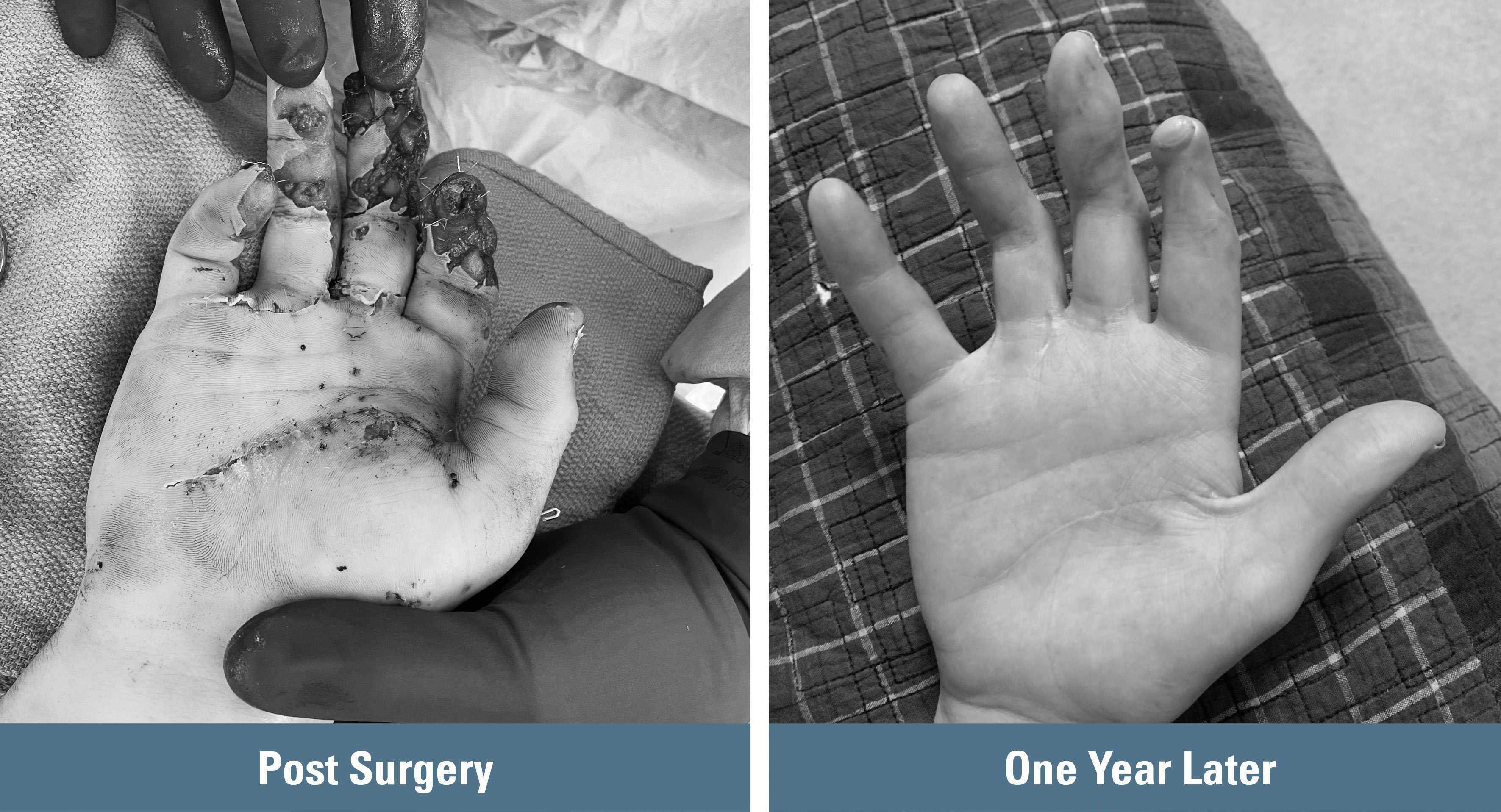 Before-and-after image of Tanner's hand immediately post-surgery, and one year later. (Photo provided by patient)
