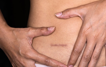 Photo of scar after appendectomy. The study shows 7 in 10 participants avoided an operation for appendicitis by first trying treatment with antibiotics. (Photo credit: Getty Images)