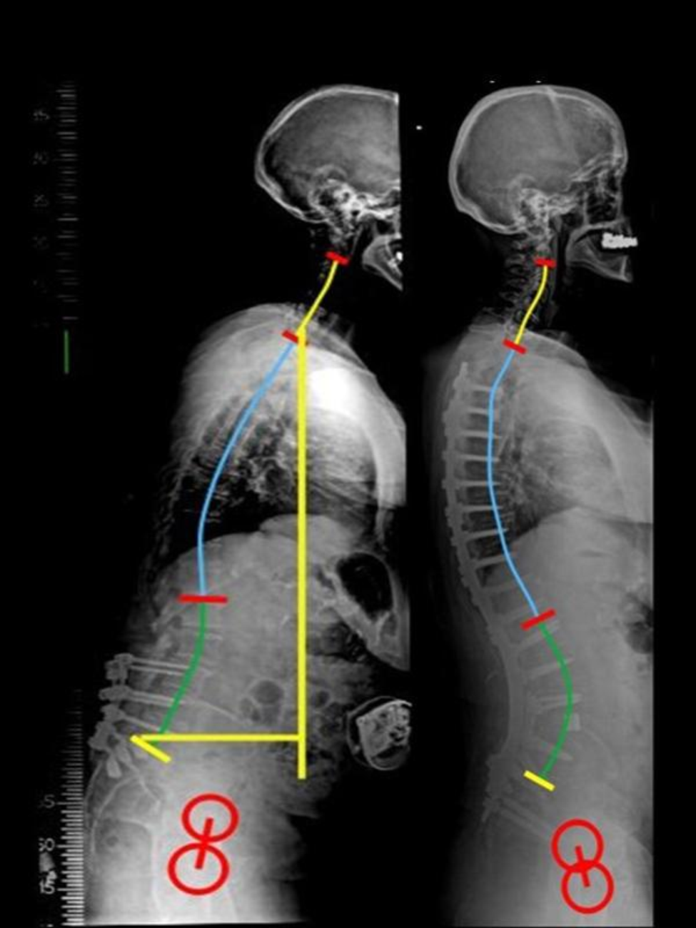 Side X-ray images taken of Ruth's spine, before (left) and after (right) surgery. (X-ray images provided by Dr. John C. Quinn/UTHealth Houston)