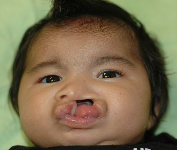 By the time Jae was about 3 months old, he needed surgery to repair his cleft lip. 