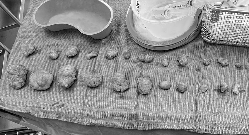 Le’s fibroids lined up on a surgical table after her procedure. (Photo courtesy of Ha T. Nguyen, MD)