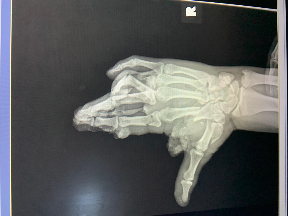 X-ray of Tanner’s hand prior to surgery. (Photo provided by doctor)