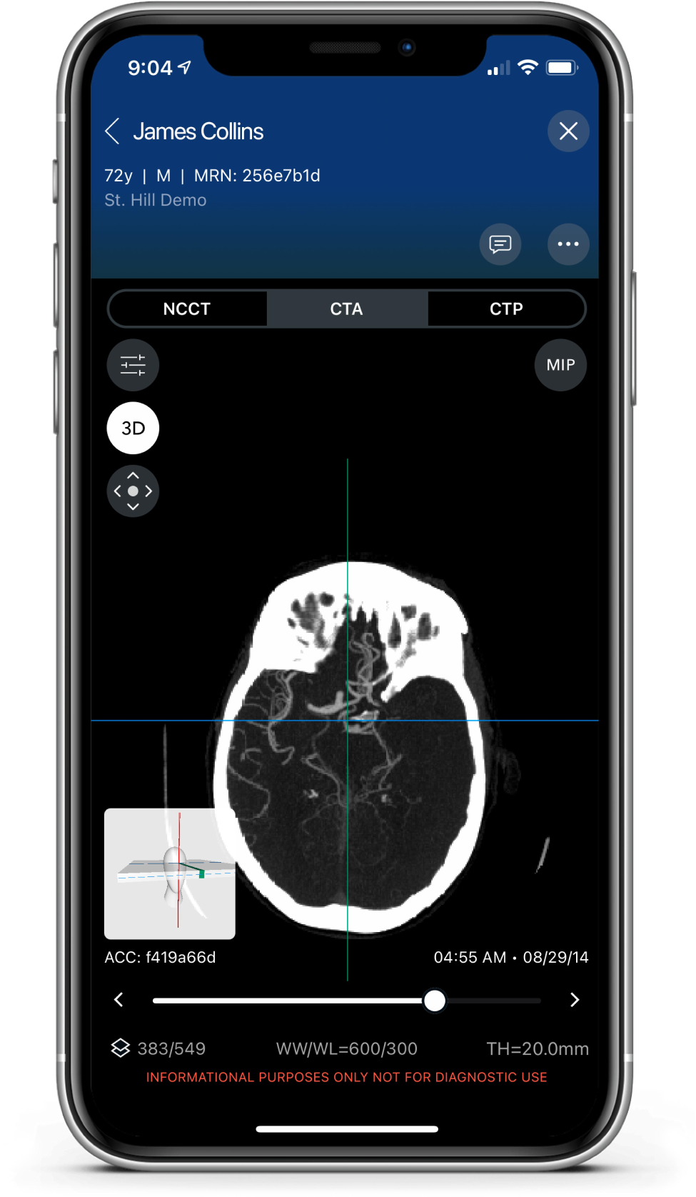 Viz LVO allows clinicians and radiologists to receive real-time alerts to their mobile phones, notifying them of possible LVO within moments of CT imaging completion. (Demo courtesy of Viz.ai)