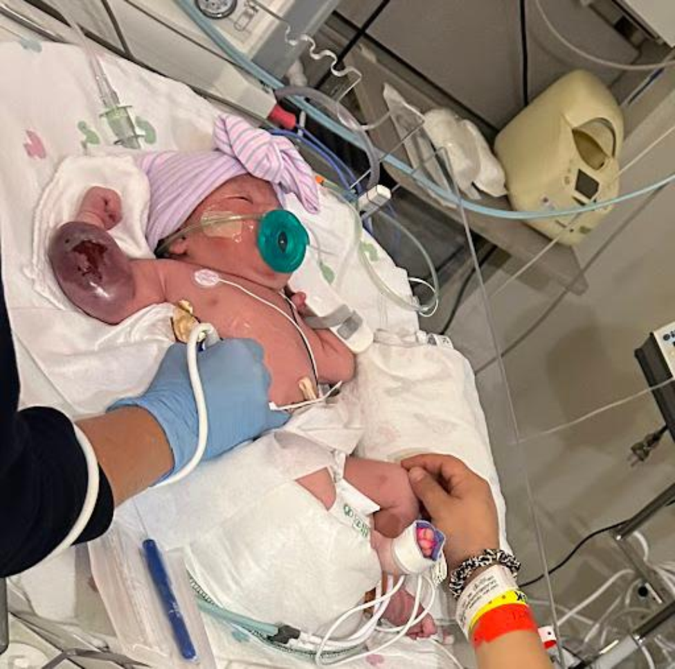 Isabella's large AVM of the arm, pictured, caused her to enter heart failure and pulmonary hypertension several days after birth. (Photo courtesy of Claudia Salas Melchor)