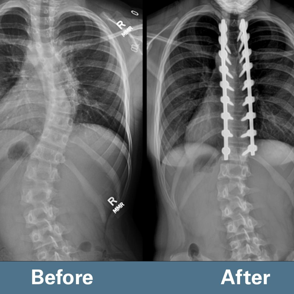 Ellison’s scoliosis curve improved from 48 degrees to less than 10 degrees as a result of bracing and spine surgery.