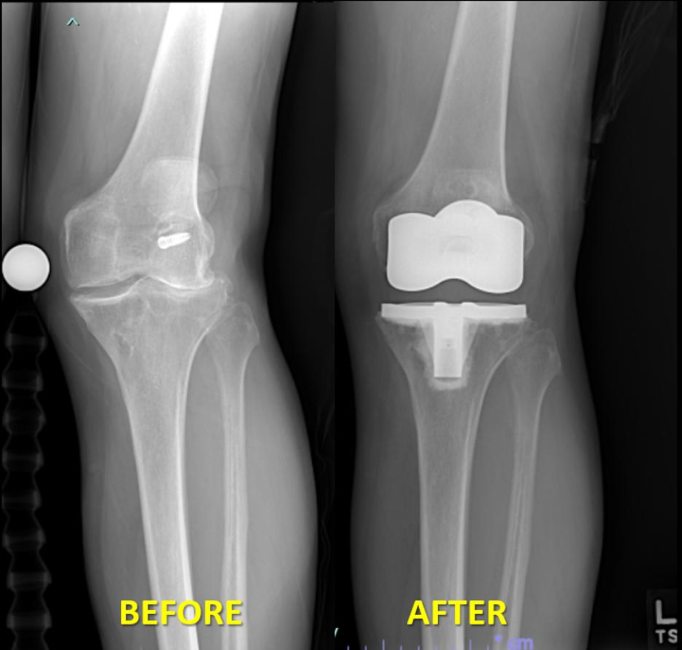 Roy Gray had bone-on-bone before his knee replacement and lived with pain. Now, his knee is strong and supports his love of slalom skiing again. (X-ray provided by Radwan)
