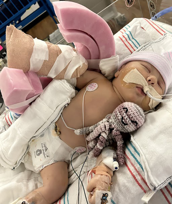 At just 2 weeks old, Isabella Halligan underwent surgery, with a tourniquet placed under her shoulder to lower risk of future arm amputation.