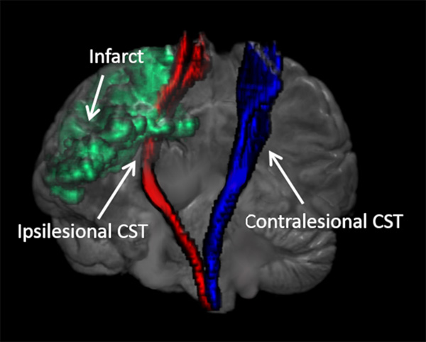 Tractography - Tractography of the corticospinal tracts Image